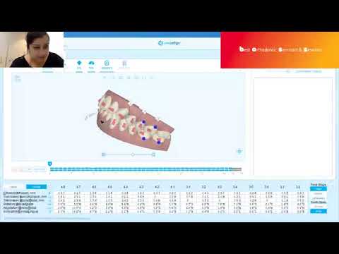 Class I crowding case - Invisalign Clincheck