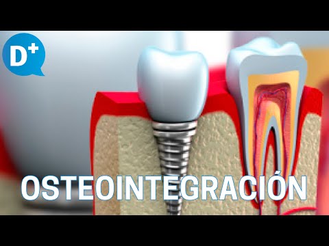 ¿Qué es la osteointegración?