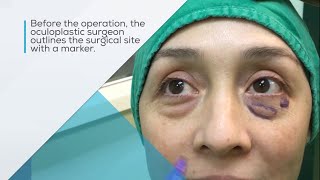 Lower eyelid blepharoplasty: surgery to remove bags under the eyes