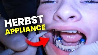 Patient Getting a Herbst Appliance… full walkthrough | Orthodontist explains