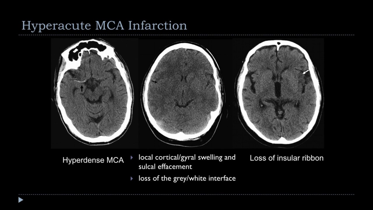 CT brain interpretation in Emergency Practice Part 3