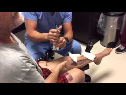 Removal of external fixation leg