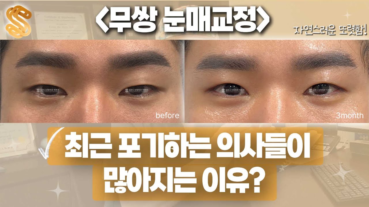무쌍 눈매교정 포기하는 의사들이 많은 이유? #무쌍눈매교정유명한병원