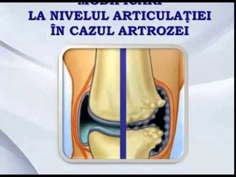 tratamentul articular al argintului