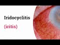 Iridocyclitis iritis