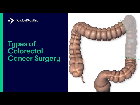 Types of Colorectal Cancer Surgery | What are the Different Operations We Can Perform?