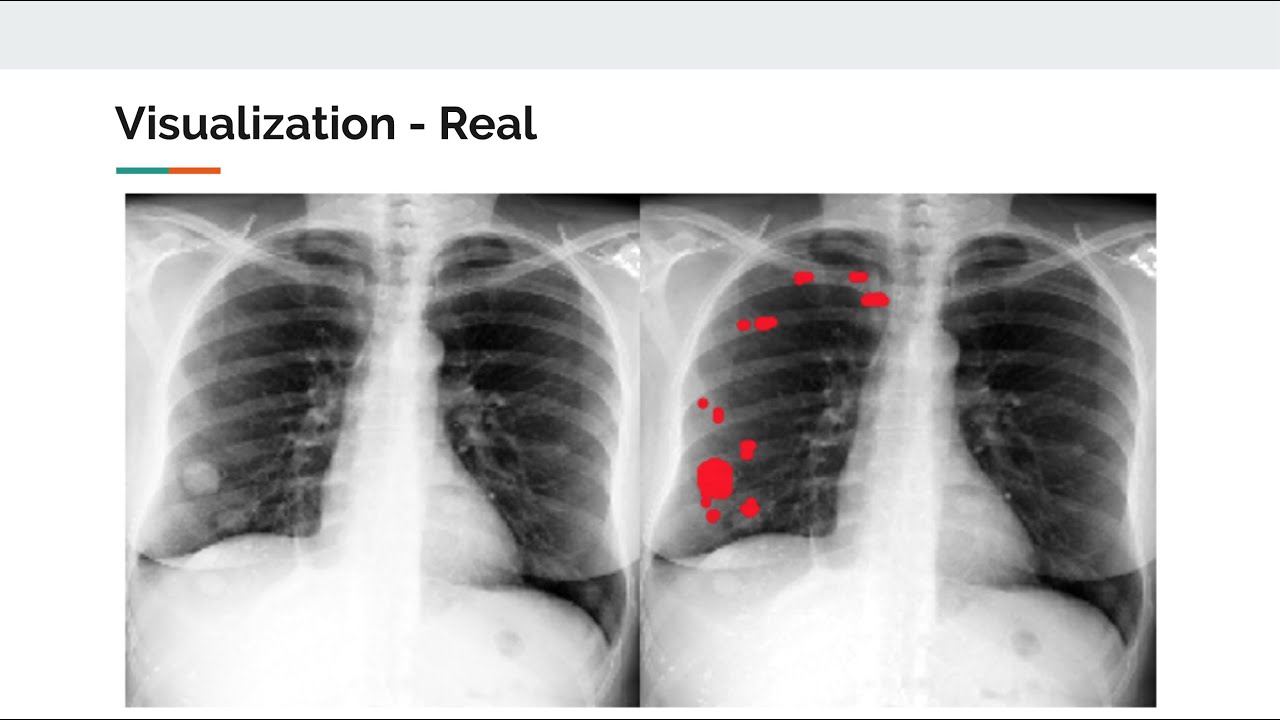 Training a Deep Convolutional Neural Network to Detect Early Stage Lung Cancer