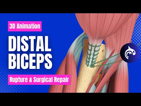 Distal Biceps Rupture and Surgical Repair - 3D Animation