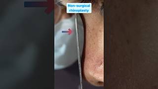 Non-Surgical Rhinoplasty Instant Nose Transformation: #shorts