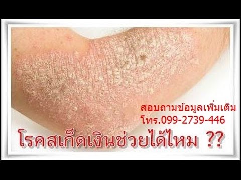ไม่ว่าจะมีน้ำตาลในโรคสะเก็ดเงิน ไม่ว่าจะเป็นโรคสะเก็ดเงินขัด