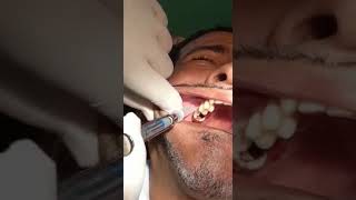 Extracción  Dental #cirugiaoral#extracciondental