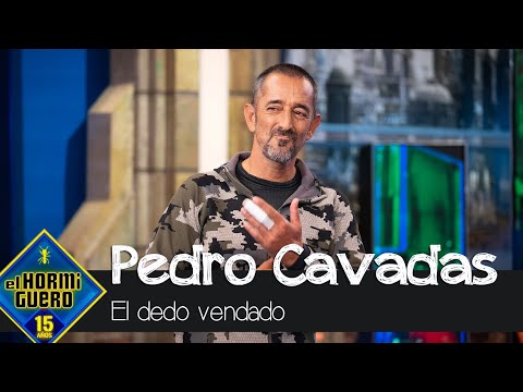 Pedro Cavadas revela por qué lleva el dedo vendado - El Hormiguero