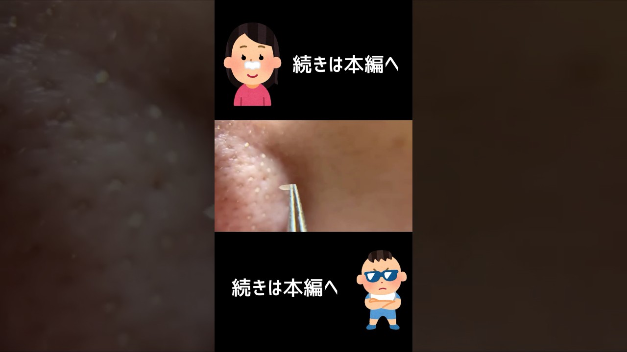 でっかい角栓とれた