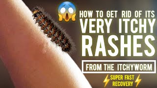 How to Get Rid of ITCHYWORM Rashes (No more itch!) | GOOD HEIGHTS