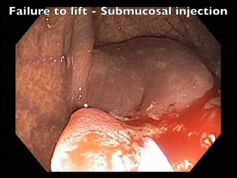 Endoscopic Signs of Cancer in a Flat Lesion