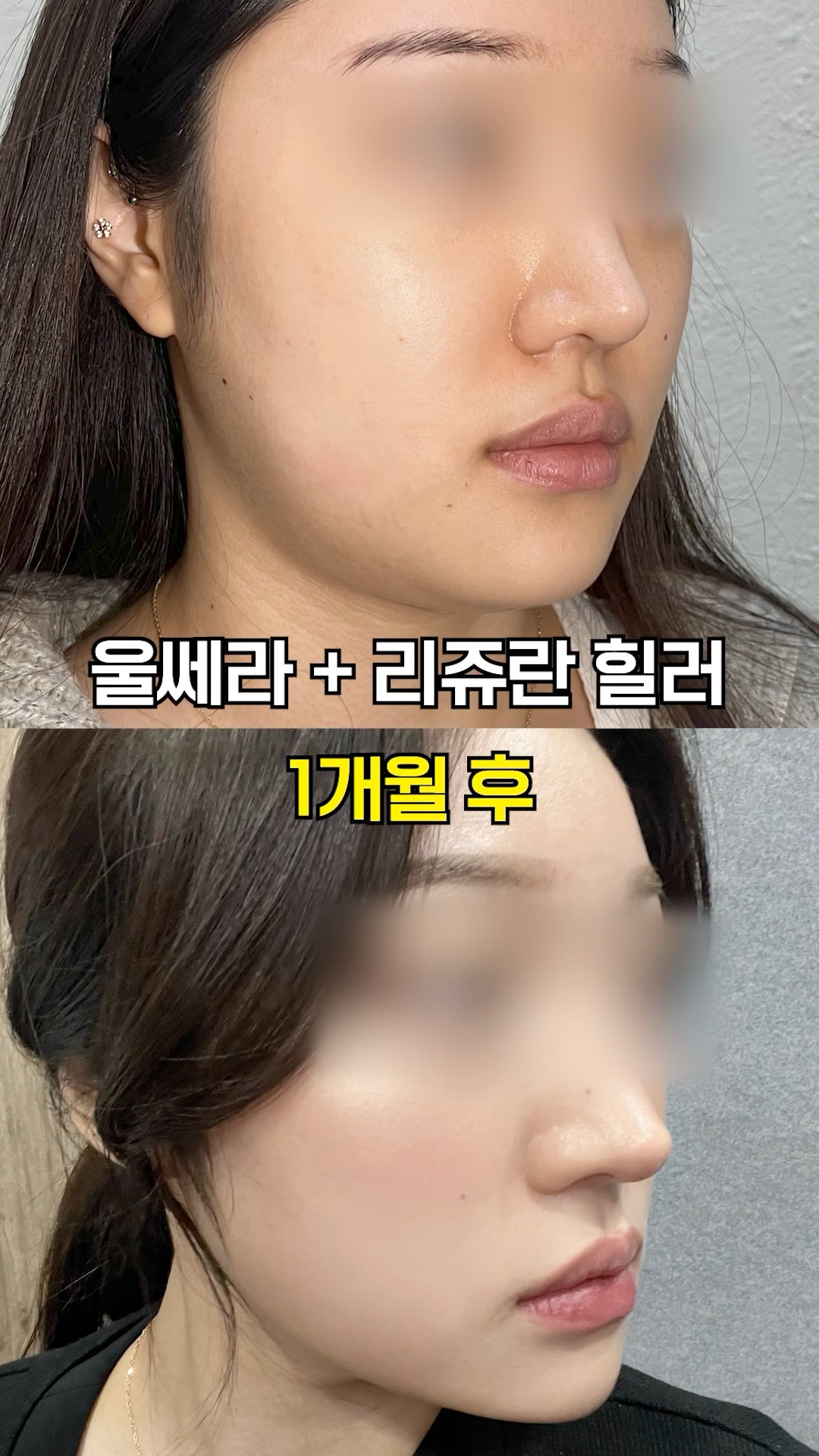 울쎄라+리쥬란 전후