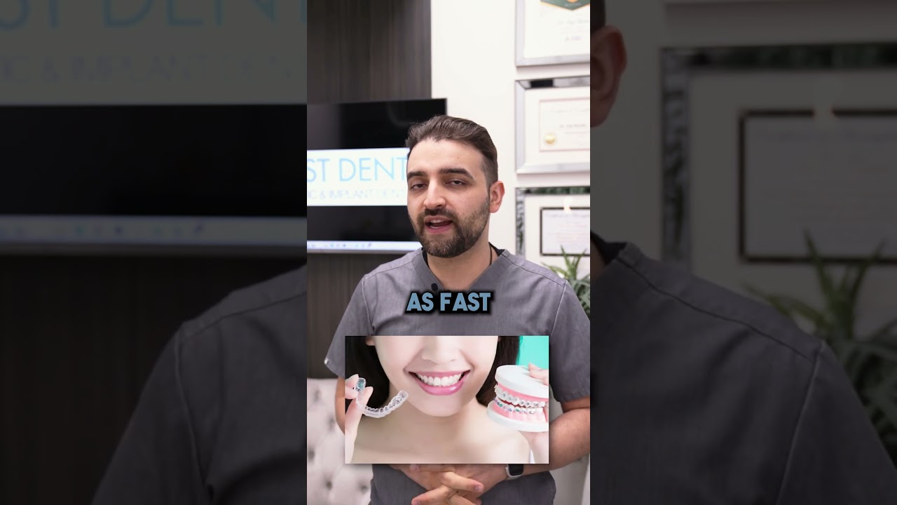 Clear Aligners Treatment Time