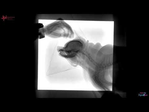 JPI DynaVue Fluoroscopy | Pharyngeal Collapse