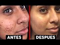 Como Quitar un Grano [Descubre el Secreto que los Dermatólogos no Quieren que Sepas] ¡Elimínalo YA!