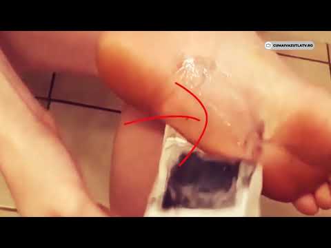 Warts on hands removal