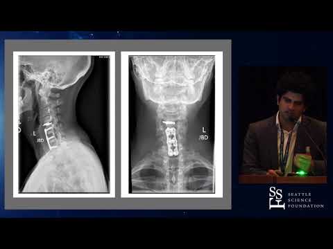 Mobi c failures in cervical arthroplasty patients   Varun Yadav, MD