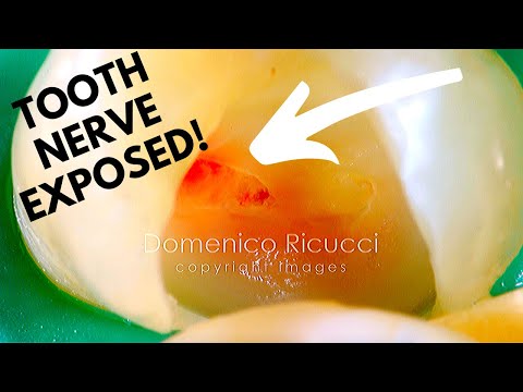 Tooth Cavity - Partial Pulpotomy Part 2