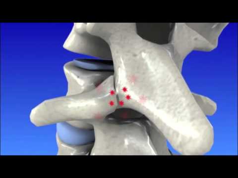 LFK Osteochondrose acute Periode Essays zum Thema Schmerzen im Rücken