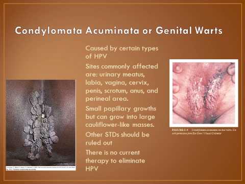 A condyloma acuminatum tünetei, kezelése és megelőzése, A páromnak condyloma van