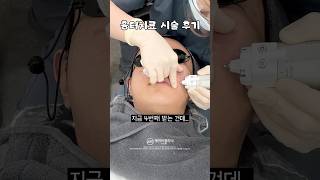 여드름 흉터치료 브이로그❗