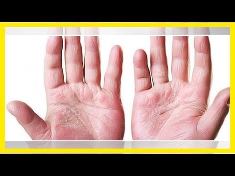 Die Behandlung von den Gräsern vom Ekzem auf den Händen Was ist асд2 beim Ekzem