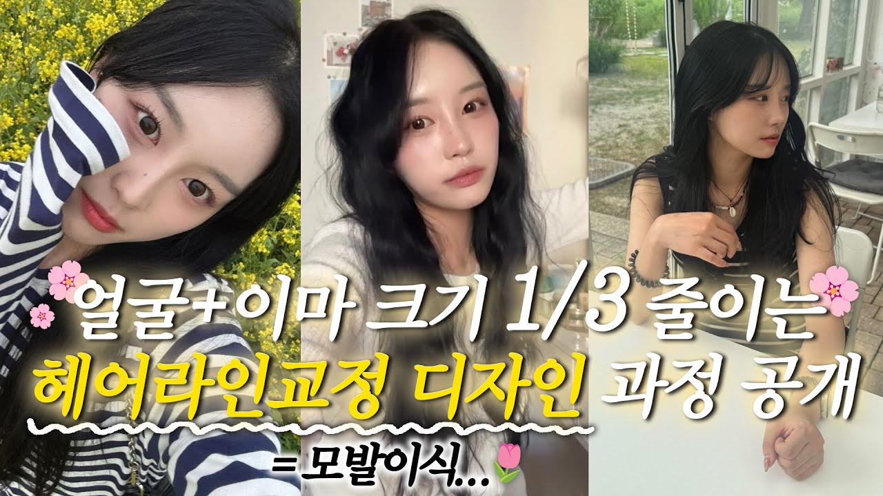 넓은이마, 여자 M자 이마 수술로 얼마나 달라질까? 윤곽까지 보정된다고??