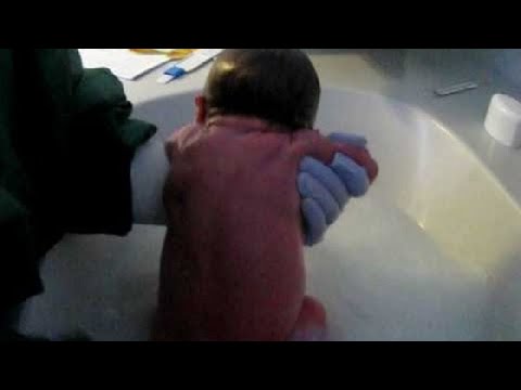 Il gidroperit per candeggiare della persona I pigmentary notano su una fronte a uomini