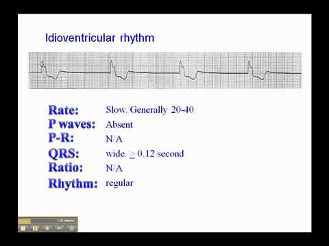 ECG: Idioventricular Rhythm