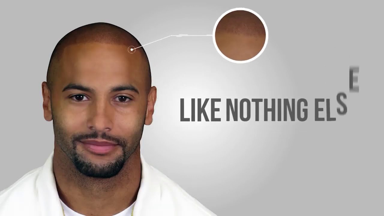 Would You Change Your Hairline if You Could?