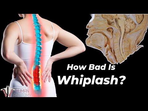 How Whiplash Can Destroy Your Neck...
