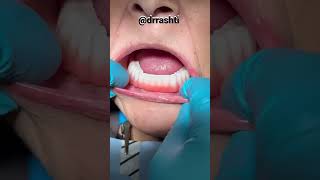 🚨New Smile Alert🚨This is a implant retained fixed bridge! Call us at (310) 623-3330!#shorts #viral