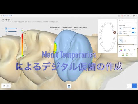生命歯学科 若い先生にオススメするデジタル歯科治療「Medit Temporaries」によるデジタルな仮歯の作り方