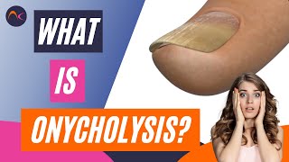 What is Onycholysis Nail lifting and Separation Explained!