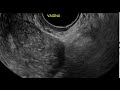 Video 5 Normal Vagina