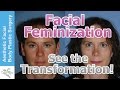 Transgender Facial Feminization FFS MTF M2F Plastic Surgery Video By Seattle Bellevue S Dr Young