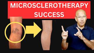 Microsclerotherapy Masterclass: Professional Injection Techniques & Aftercare for Leg Spider Veins