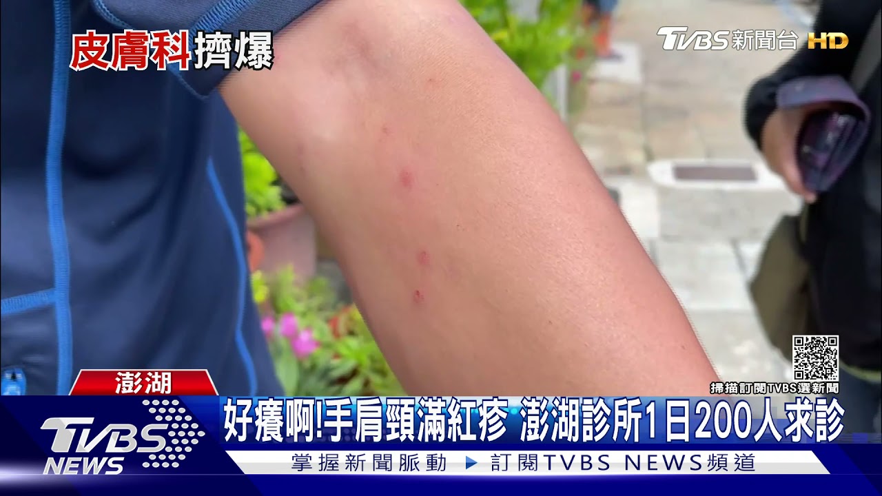 好癢啊!手肩頸滿紅疹 澎湖診所1日200人求診