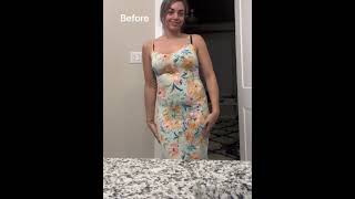 When I Get My Body Done... | Dr. William | BBL Results #miamiplasticsurgery #bbl #drwilliammiami