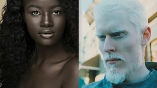 5 People with Unique Skin Color
