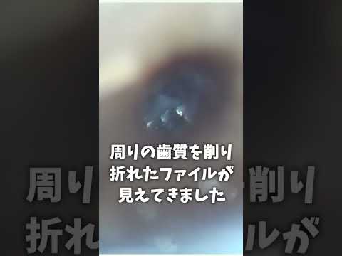 生命歯学科 マイクロスコープを用いた破折ファイルの除去！根管内で折れた器具（ファイル）の除去を詳しく解説します！#shorts