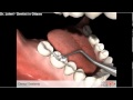 Preventive Dental Sealants No Drill Ottawa Dentist