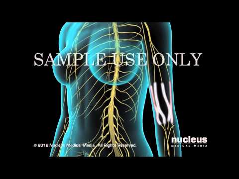 Fibromialgia
