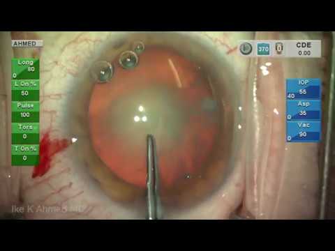 Routine Cataract Surgery 