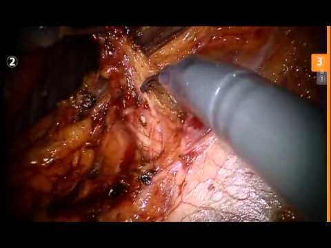 Częściowa resekcja nerki lewej w asyście robota chirurgicznego 