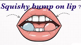 Squishy Lip Bump It Might Be a Mucocele (Mucous Cyst) | Causes, Symptoms & Treatment #Mucocele #Lip